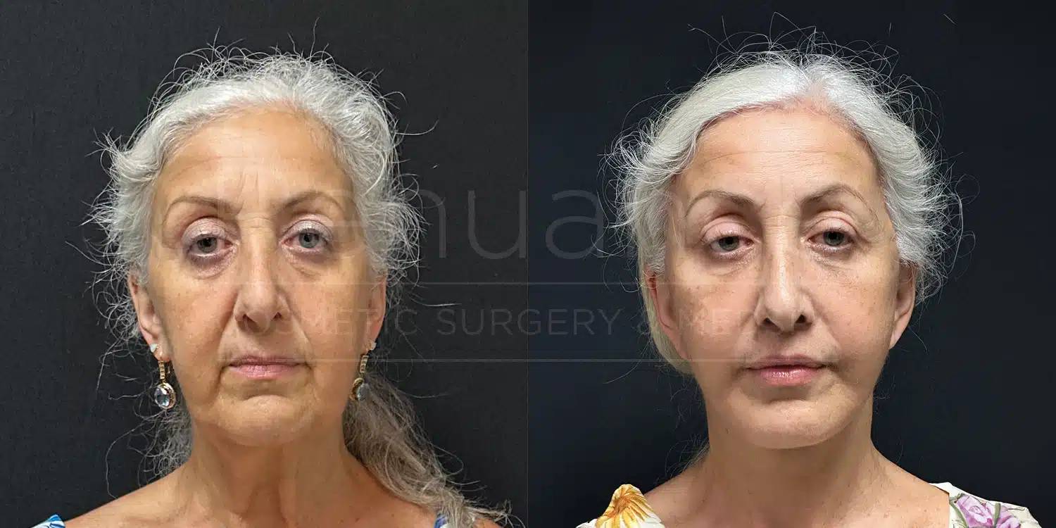 Upper blepharoplasty with brow lift and facelift, before and after, front view