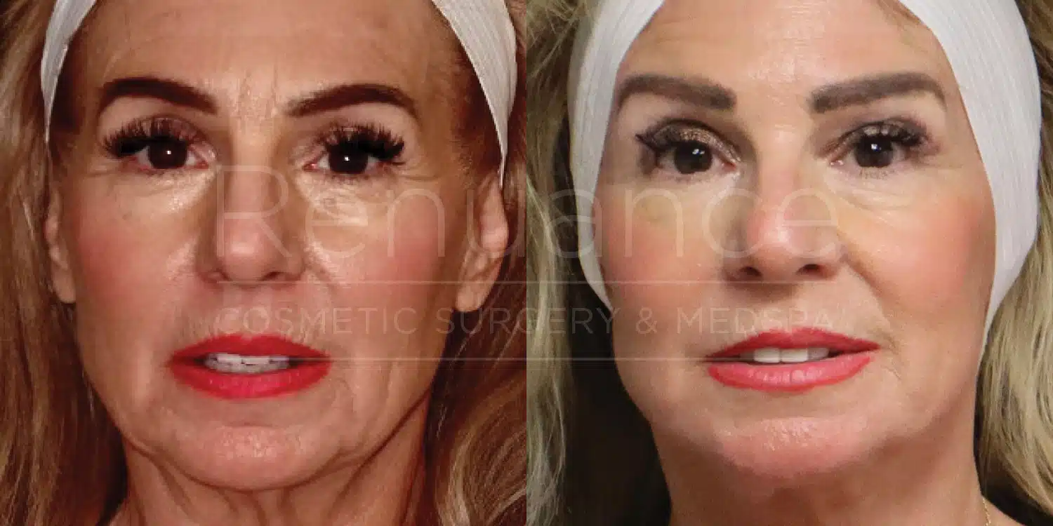 Facelift before and after at Renuance