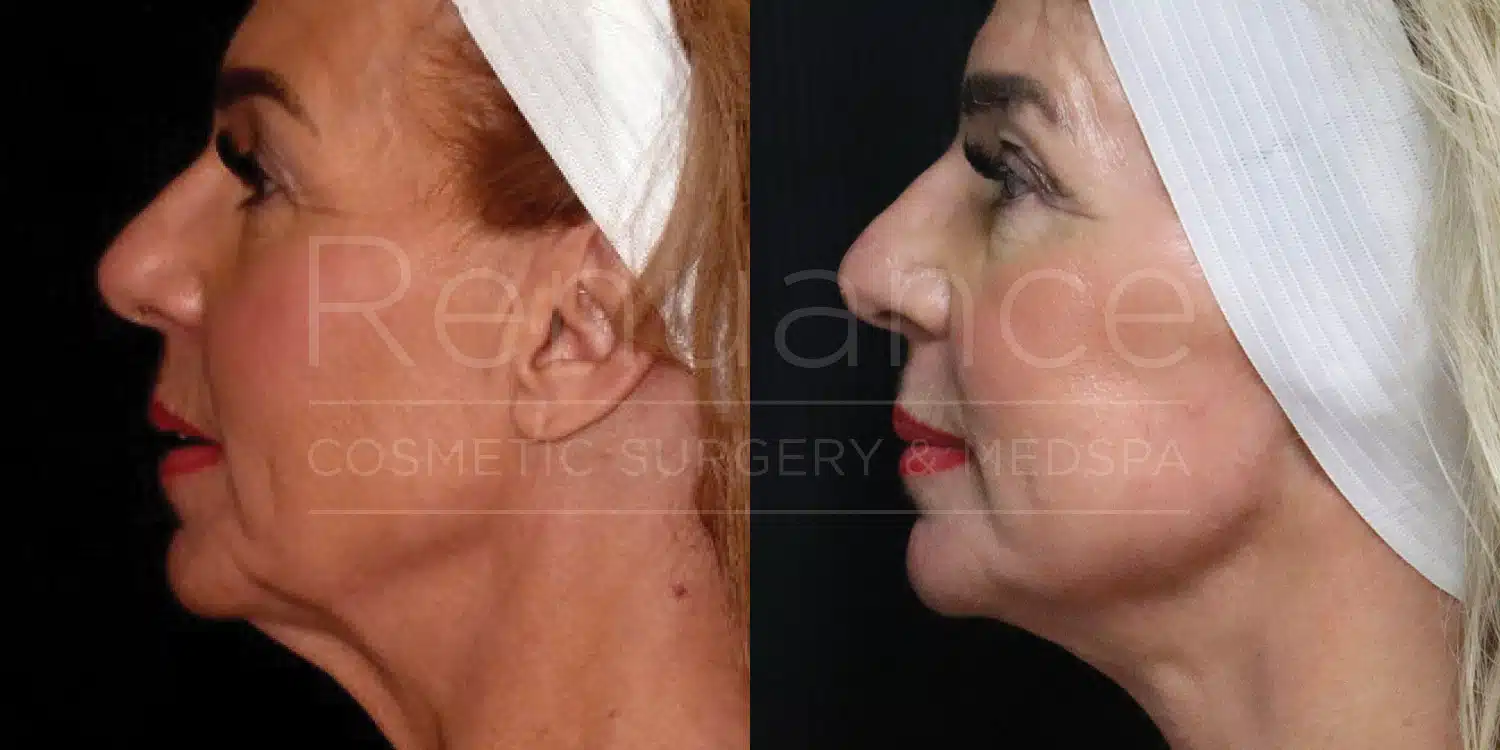 Facelift before and after, second view at Renuance