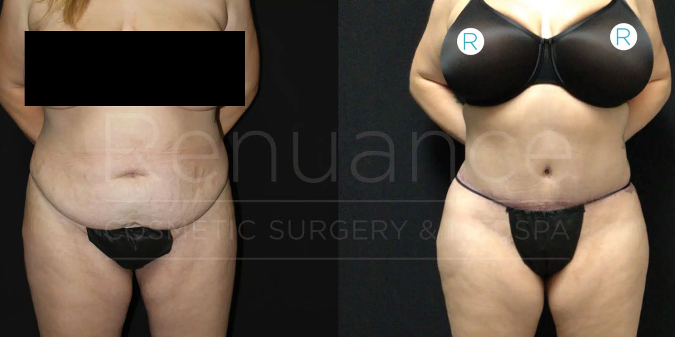 Liposuction and tummy tuck before and after at Renuance
