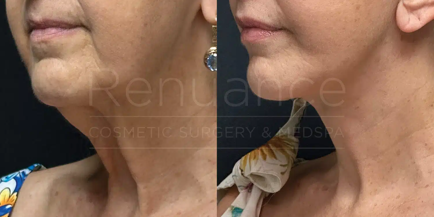 Deep plane face and neck lift before and after, side view at Renuance