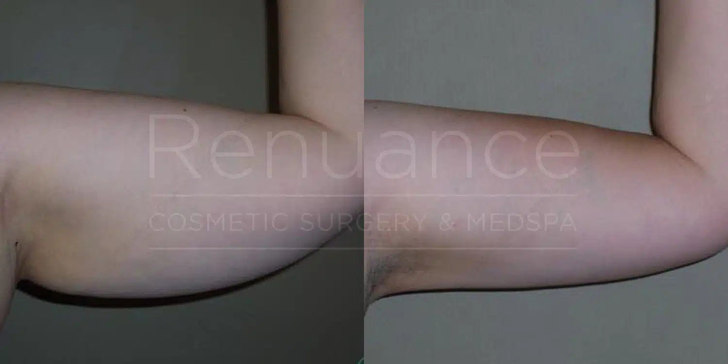 Arm liposuction before and after at Renuance