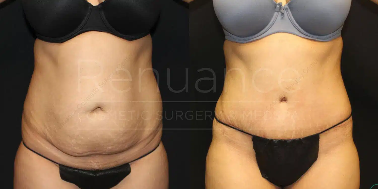 Tummy tuck before and after at Renuance