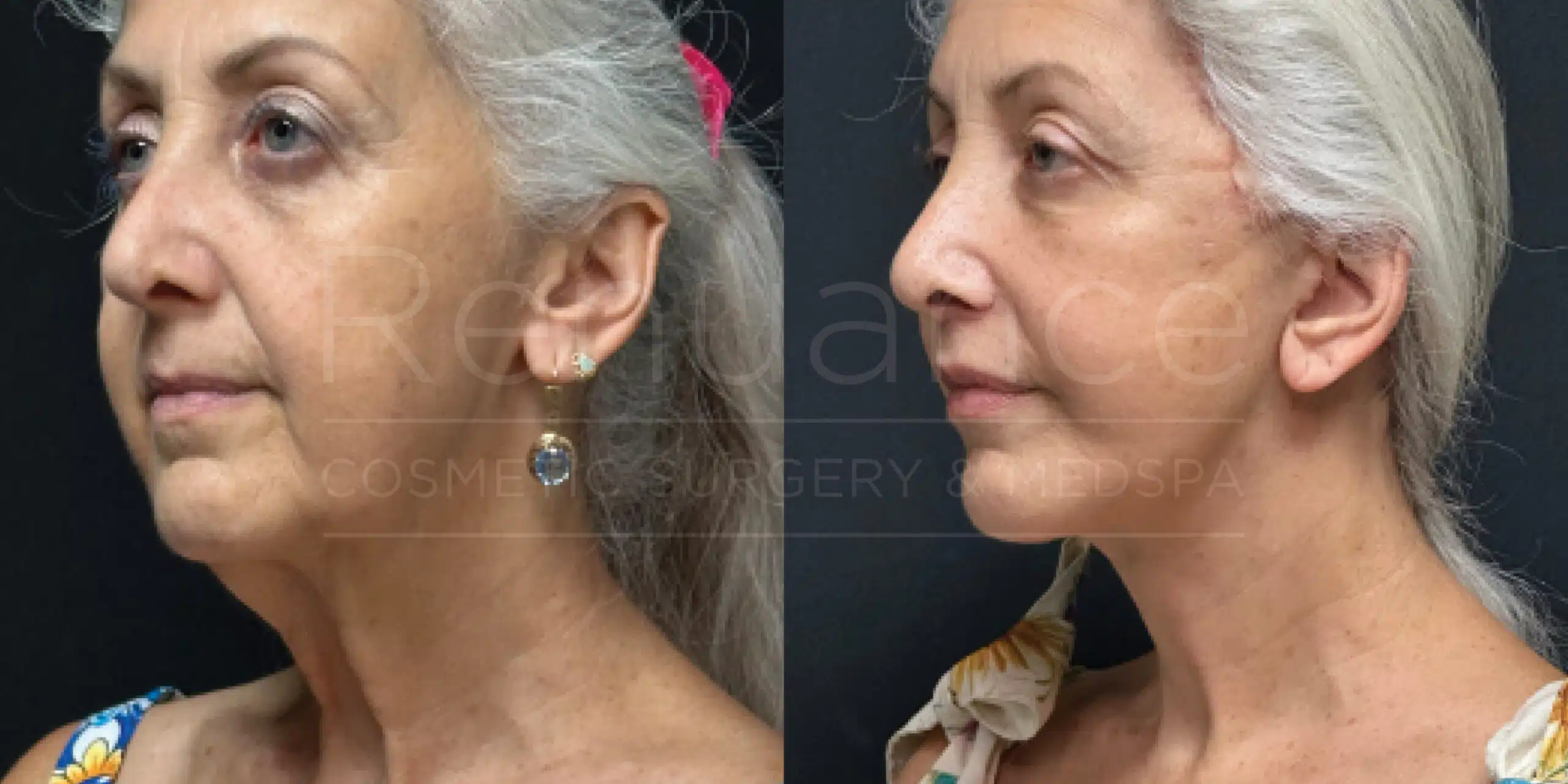 Upper blepharoplasty with brow lift and facelift, before and after, angled view
