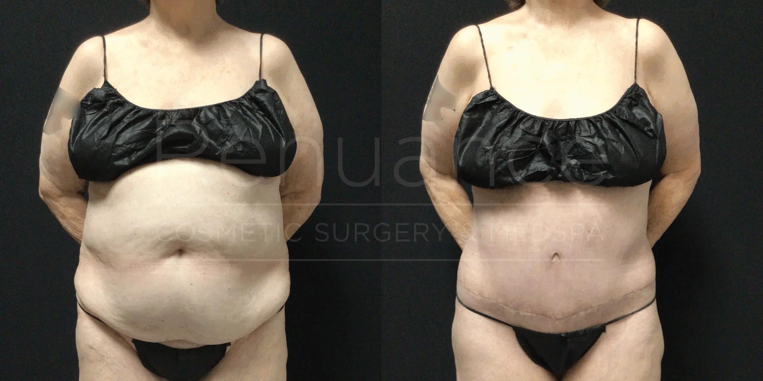 Abdominoplasty before and after at Renuance