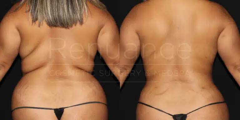 Back liposuction before and after at Renuance