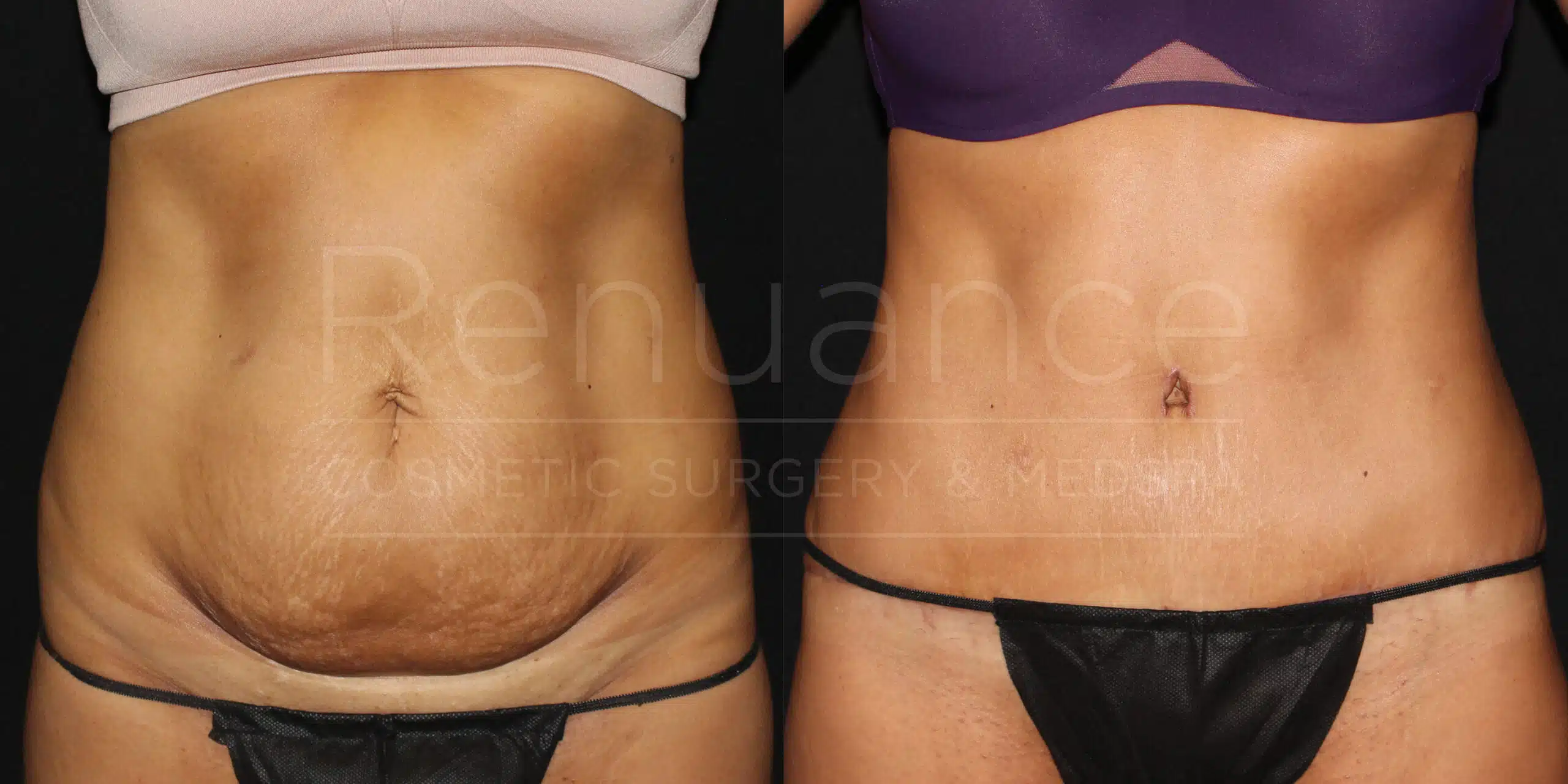 Tummy tuck before and after at Renuance