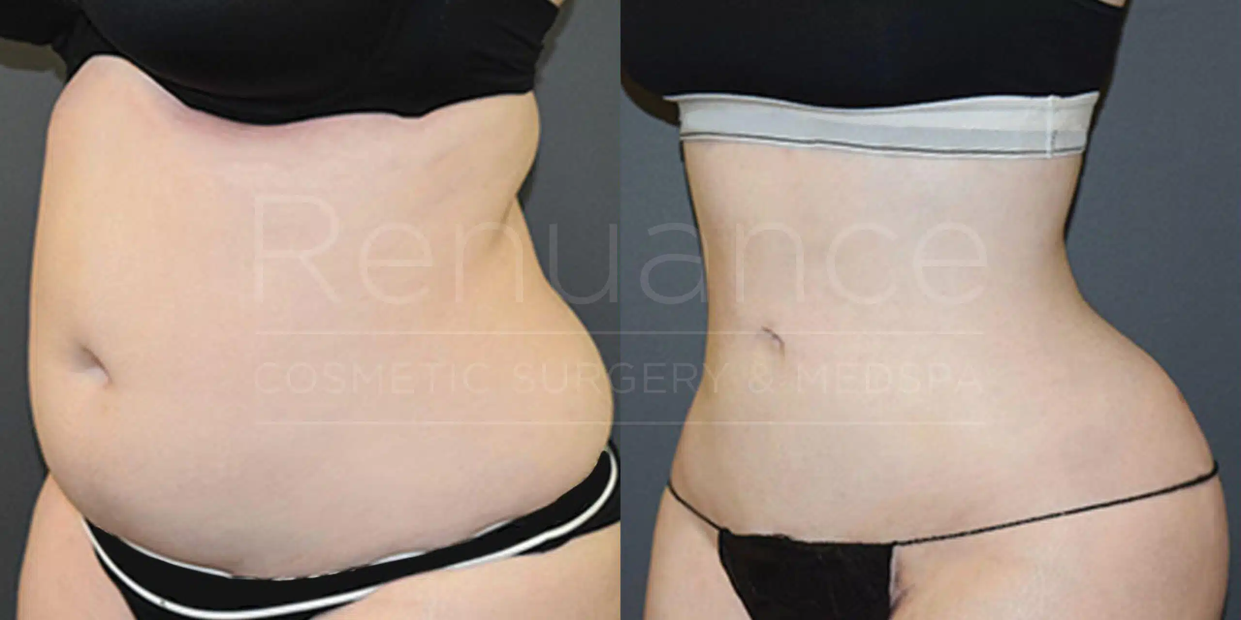 VASER liposuction before and after at Renuance