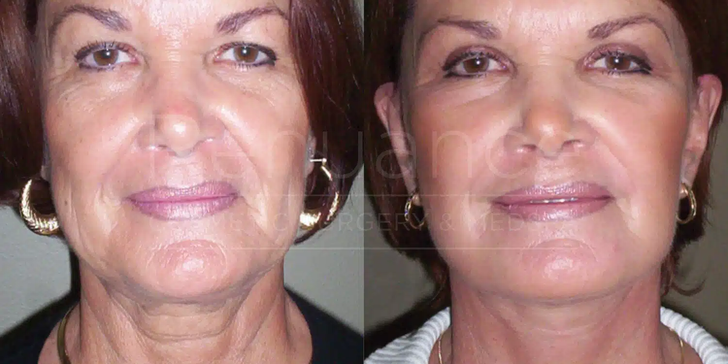 Facelift before and after at Renuance