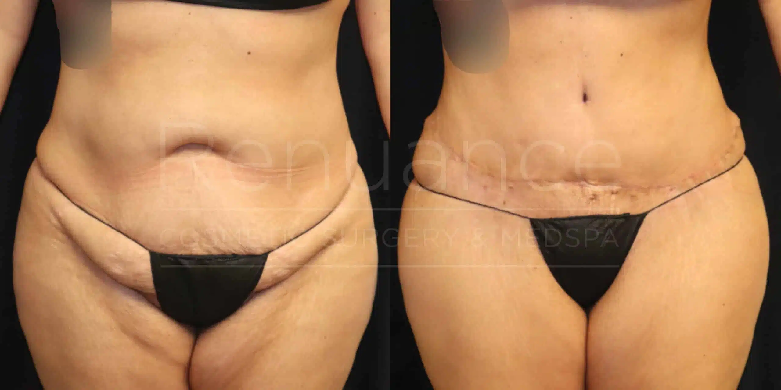 Liposuction and tummy tuck before and after at Renuance
