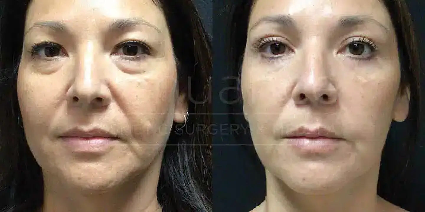 Lower blepharoplasty before and after at Renuance