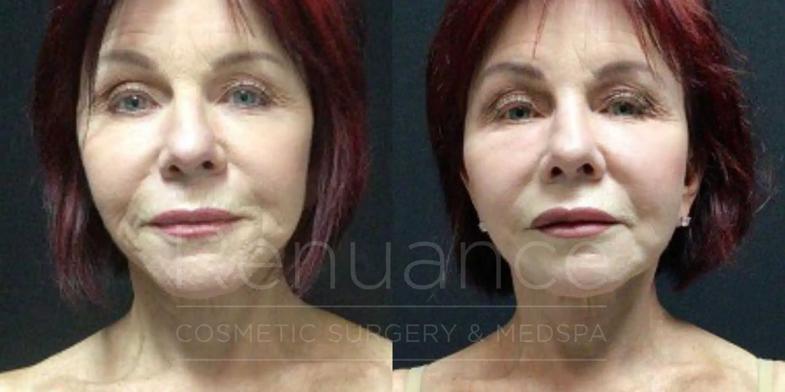 Facelift and neck lift before and after at Renuance