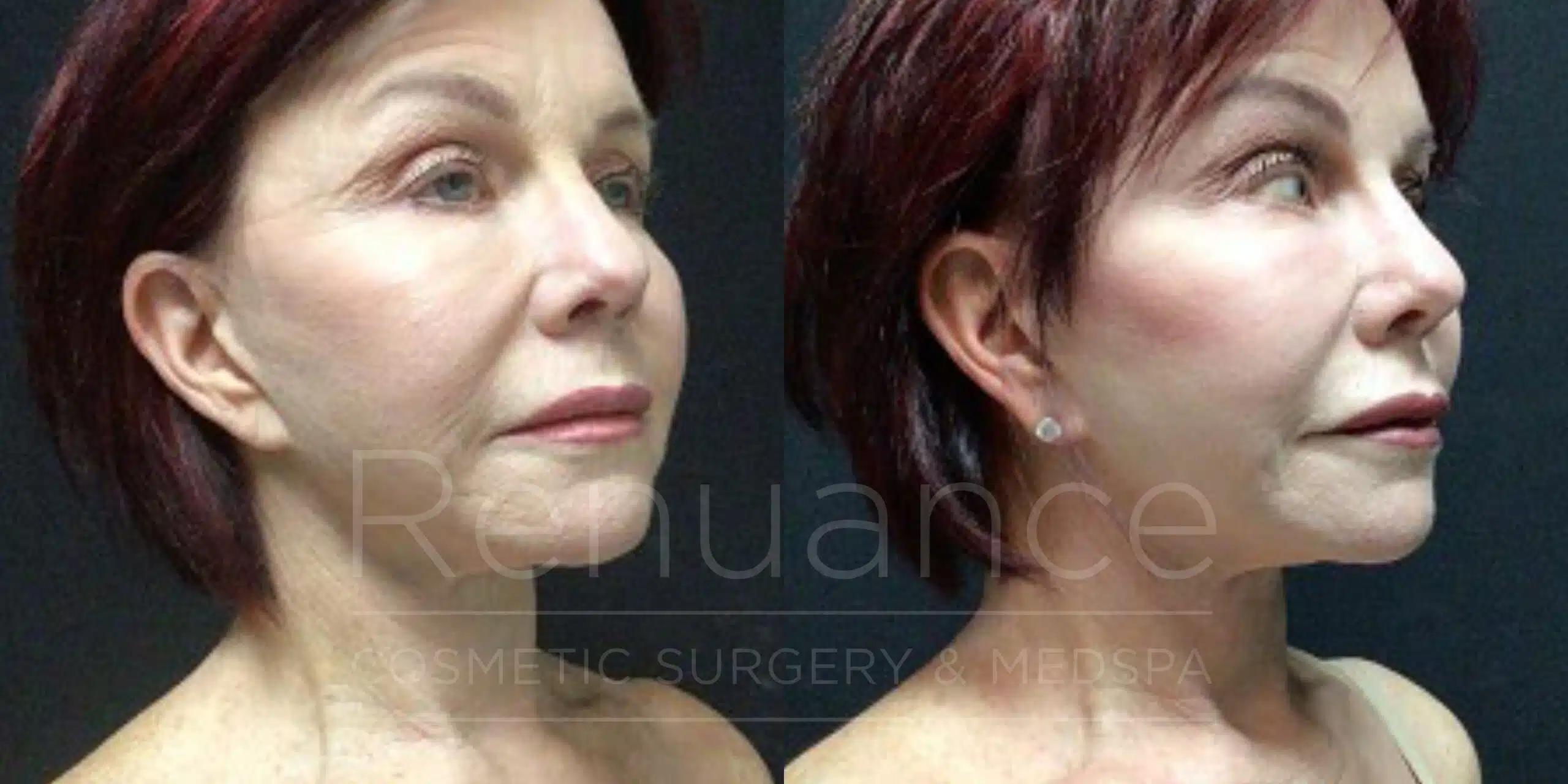 Facelift and neck lift before and after, second angle at Renuance